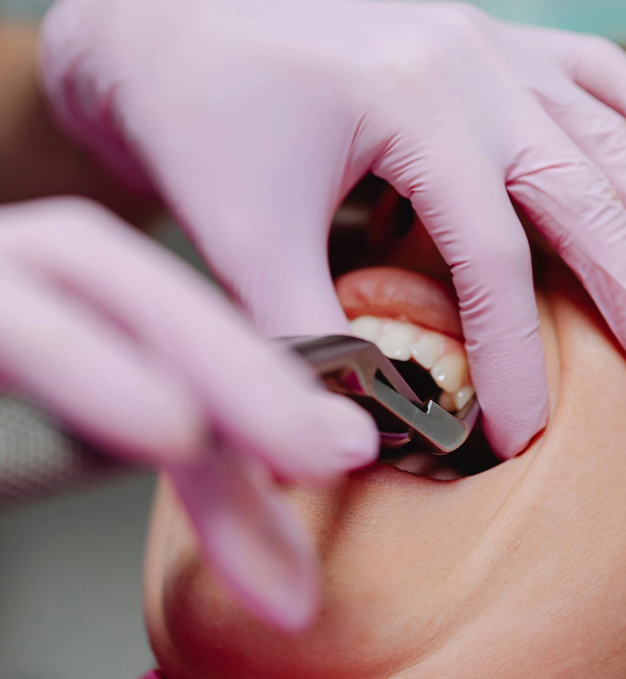 Dental Extraction