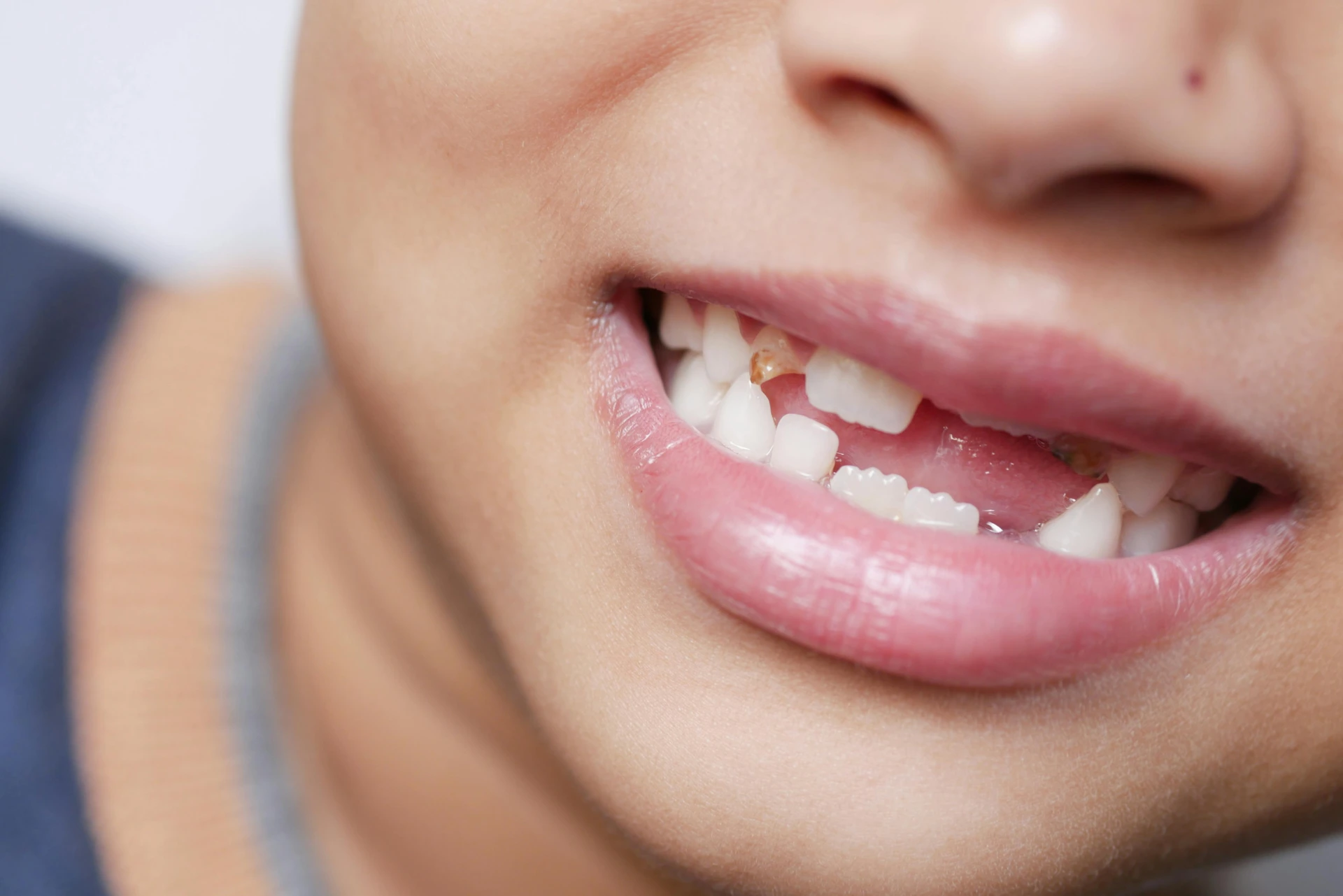 Fixing Dental Gaps and Tooth Reshaping